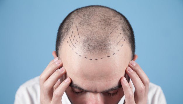 Hair Transplant? …Don’t Forget Your MD®!